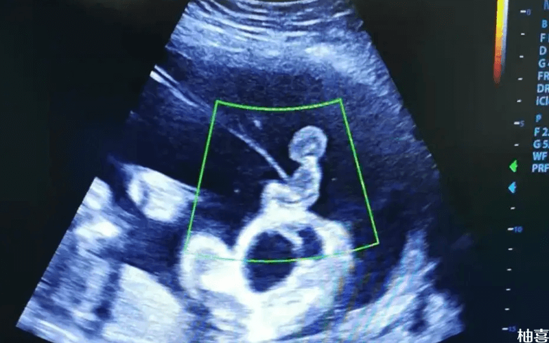 减胎手术对另一个胎儿有风险