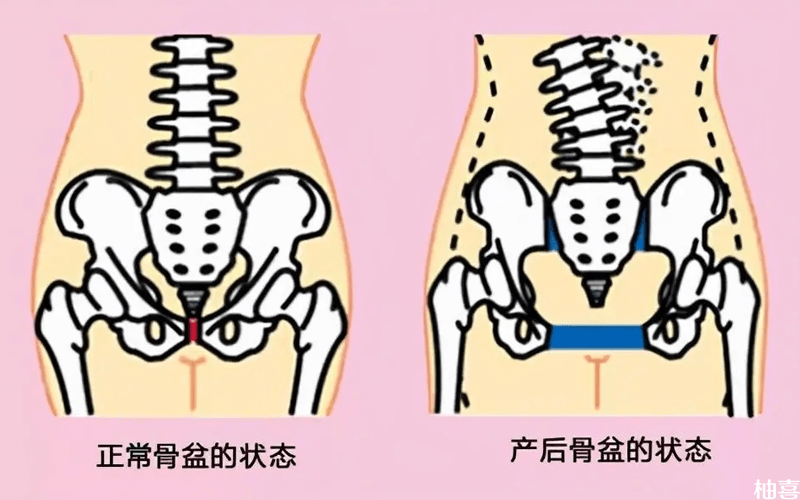 正常骨盆与生育后的骨盆有区别