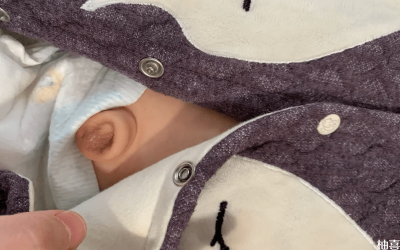 宝宝脐疝又大又圆可以用碘伏擦肚脐眼来护理吗?