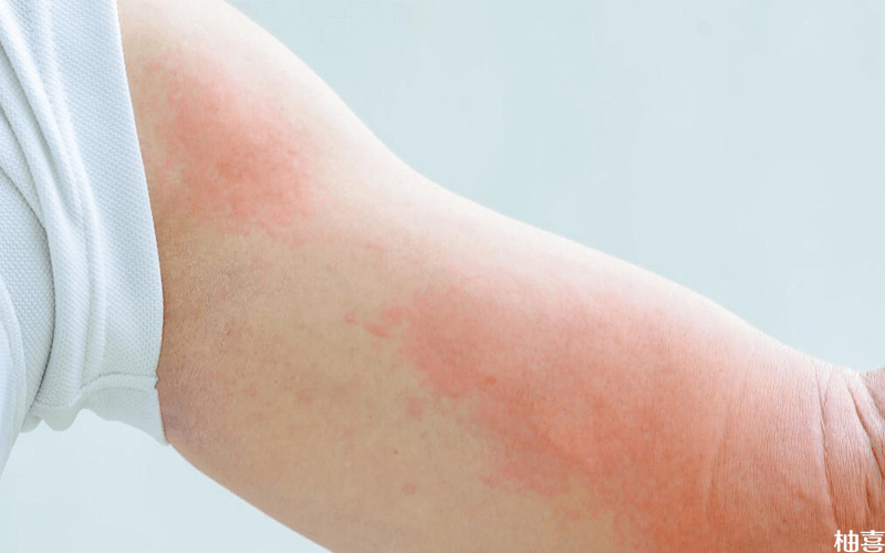 胆碱能性荨麻疹有瘙痒的症状