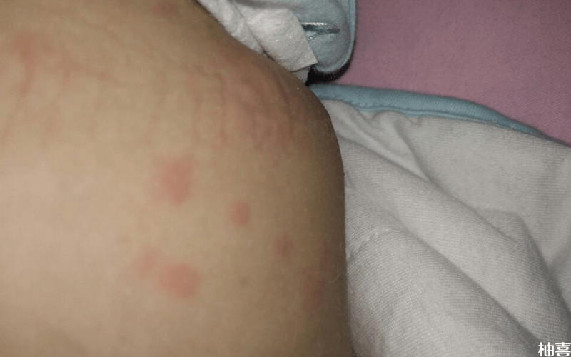 儿童荨麻疹反复要阻断过敏原