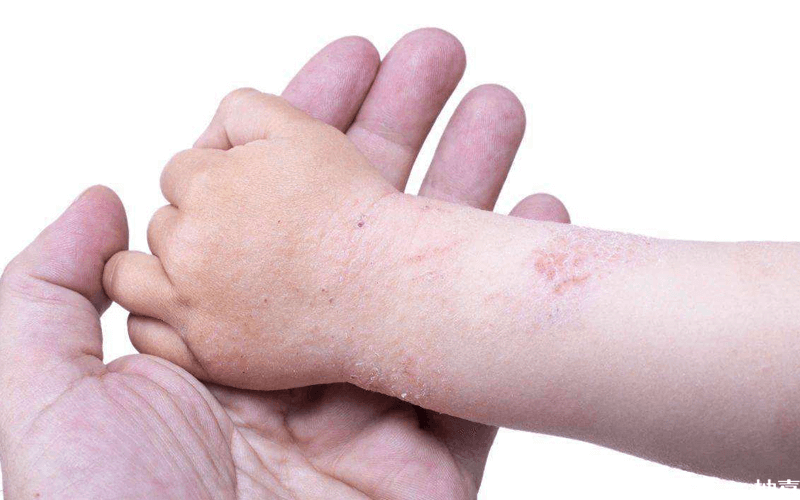 儿童荨麻疹治疗有方法