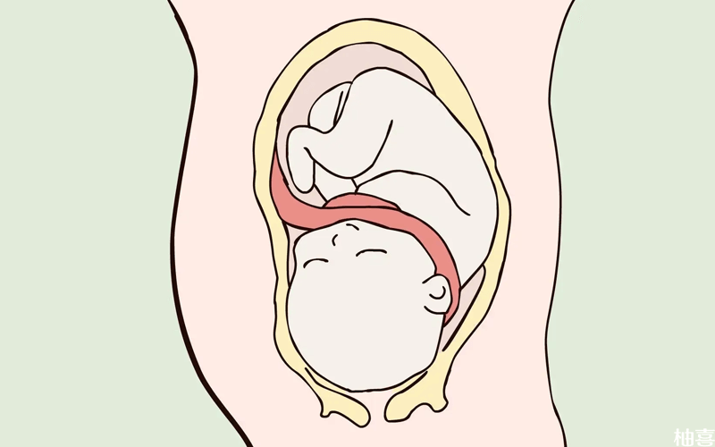 胎儿脐带过长
