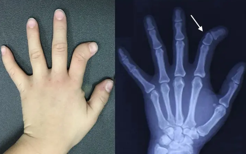 染色体基因检测能检查出a3型短指症