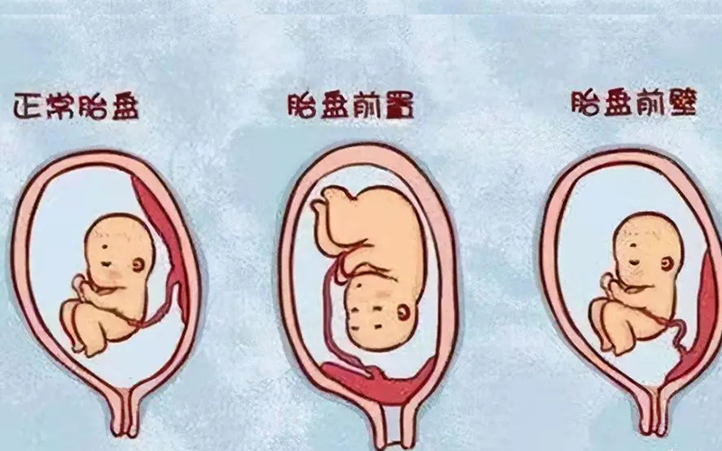 胎盘位于子宫宫底图片