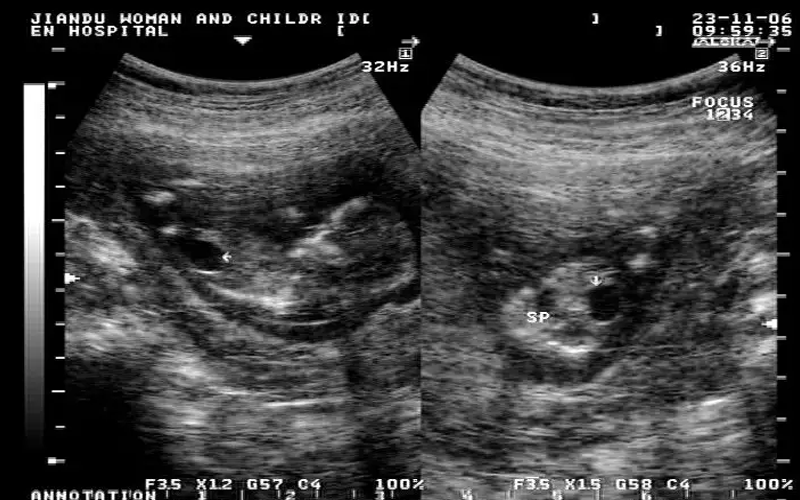 胎儿肾积水的正常值是肾盂宽度小于7mm左右