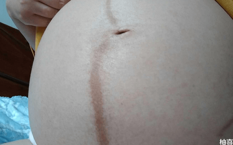 肚脐上的妊娠线上细下粗是怀男孩