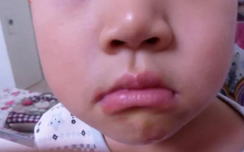 咬下唇会对孩子口腔造成不良影响