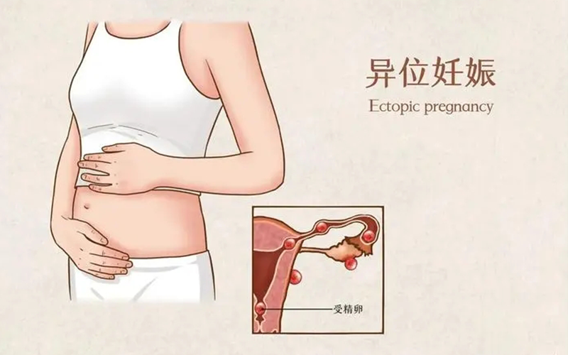 异位妊娠