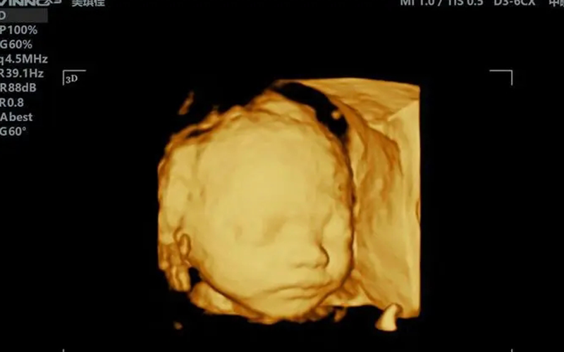 四维彩超可以很直观的看到胎儿面部的发育情况
