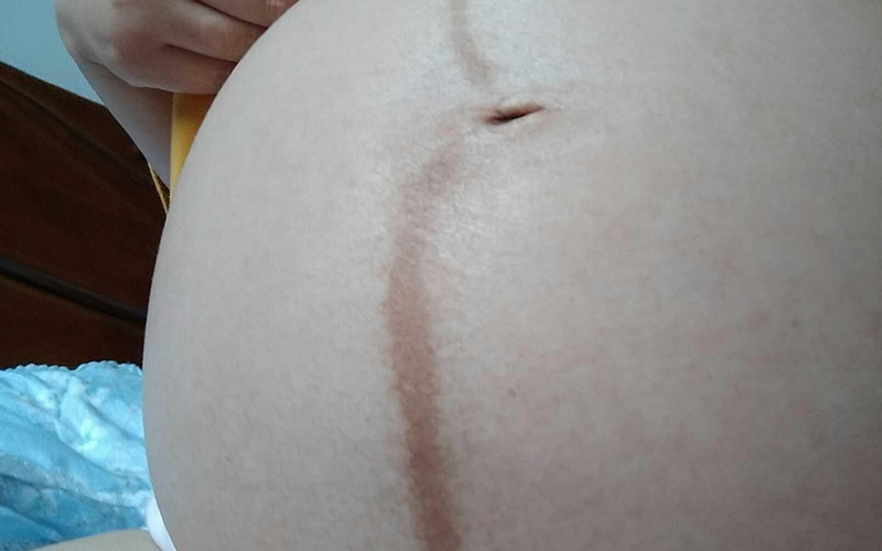 妊娠线颜色深代表怀男孩儿