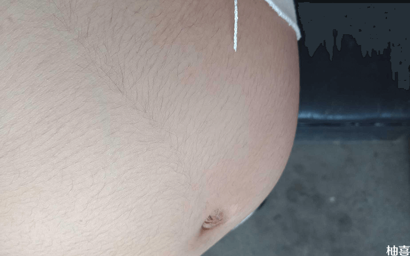 怀孕期间肚子上出现没黑线怀女宝宝