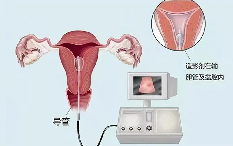子宫炎症做输卵管造影容易将炎症带入宫腔