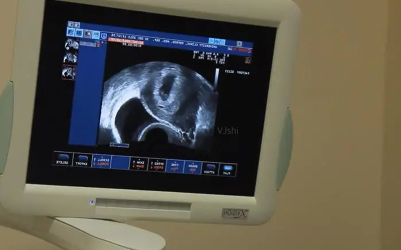 b超检查主要是判断胎儿的发育情况