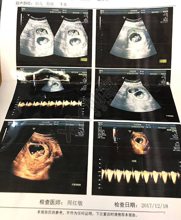 怀孕54天的宝宝图片图片